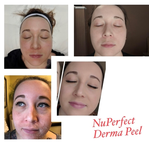 Perfect Derma Peel Med Spa In Greensboro